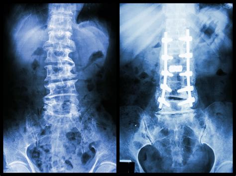 metal brackets pulled from spine|spine hardware rupture.